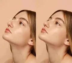 تجميل الأنف بدون جراحة: حلول سريعة وآمنة لمظهر جذاب في الصيف