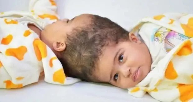 جراح سوري يقود فريقاً طبياً لفصل توأم سيامي بنجاح في السعودية: إنجاز طبي عالمي