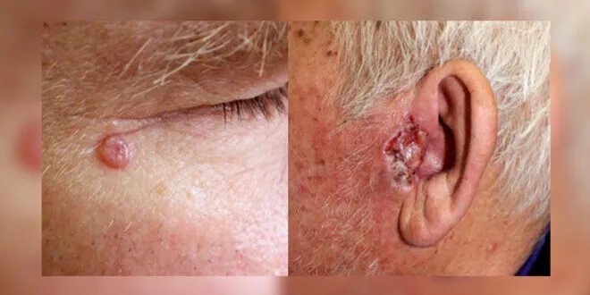 دراسة تكشف: اختلافات بين الرجال والنساء في مناطق الإصابة بسرطان الجلد وأسبابها