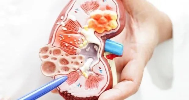 زراعة الكلى من المتوفين: أمل يلوح في الأفق.. وتشريعات ضرورية للحد من الفشل الكلوي