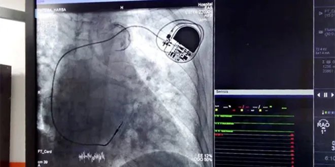 إنجاز طبي نوعي في حمص: تركيب جهاز تنظيم ضربات القلب لمريضتين في مشفى ابن الوليد مجاناً