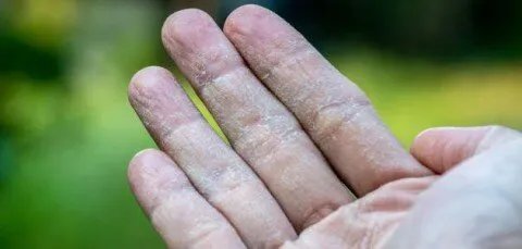 تقشر أطراف الأصابع: الأسباب المحتملة ومتى يستدعي الأمر استشارة الطبيب؟
