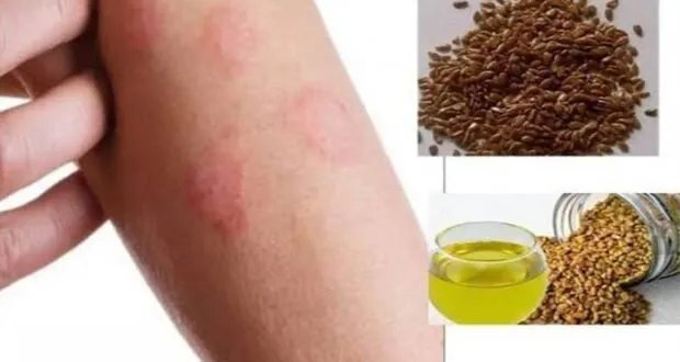 حلول طبيعية للصدفية: أعشاب تخفف الأعراض ونصائح من خبير