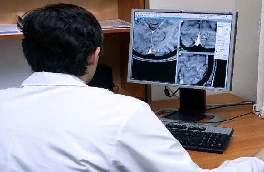 احذر العلامات الخفية: الجلطة الدماغية الدقيقة قد تكون أكثر خطورة مما تتوقع