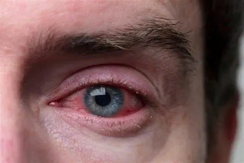 إنفلونزا العيون: عدوى فيروسية سريعة الانتشار.. الأعراض، طرق التشخيص، والوقاية