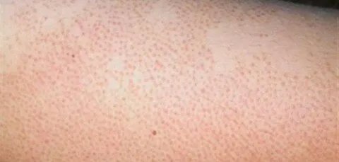 دليل شامل للتخلص من جلد الدجاجة: الأسباب، العلاجات الطبيعية، ونصائح للعناية بالبشرة