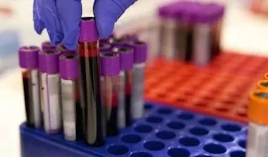 اكتشاف علمي فريد: فصيلة دم جديدة لا توجد إلا لدى امرأة في غواديلوب