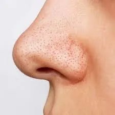 وداعًا للرؤوس السوداء: أسبابها، أنواعها، وأفضل الحلول الطبيعية لبشرة نقية