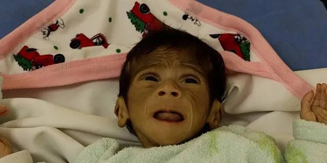 تحذير من الصحة العالمية: مستويات سوء التغذية في غزة بلغت حدًا مقلقًا مع ارتفاع الوفيات