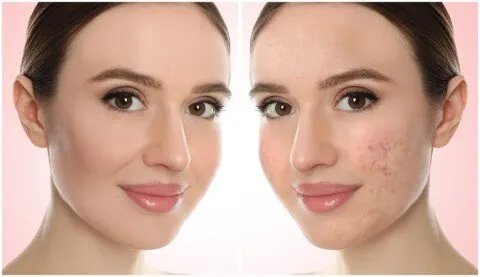 وداعاً للندبات: أحدث التقنيات الآمنة والفعالة لعلاج آثار حب الشباب والجروح