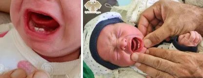 مشفى الحفة الوطني يسجل حالة نادرة: ولادة طفل بأسنان!