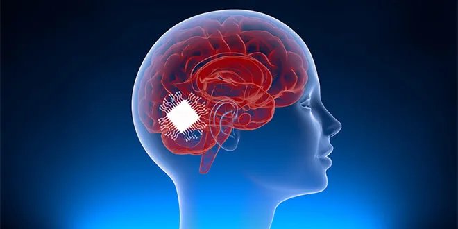 إنجاز طبي: شريحة دماغية تترجم الأفكار إلى كلمات لمن يعانون من الشلل