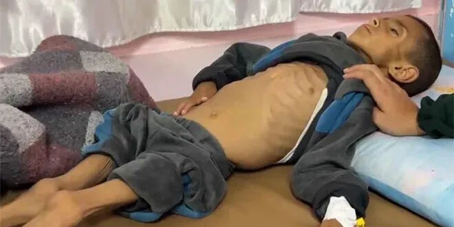 اليونيسيف تحذر: تفاقم أزمة سوء التغذية في غزة و100 طفل ينضمون للدائرة يومياً
