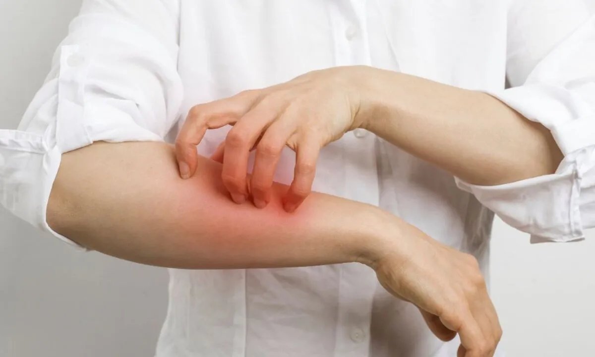 حساسية الشمس: الأعراض، الأسباب، طرق العلاج والوقاية الضرورية