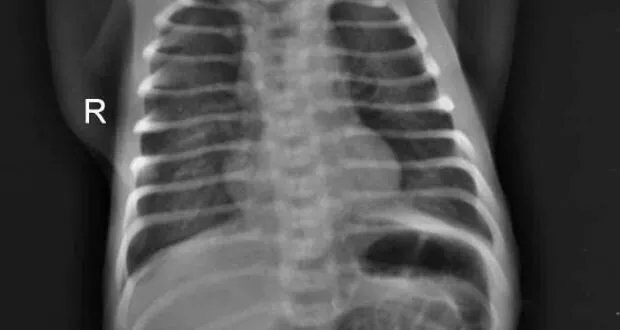 مشفى المشرق في طرطوس يحقق إنجازاً طبياً بإنقاذ حياة طفل مصاب بداء الأغشية الهلامية