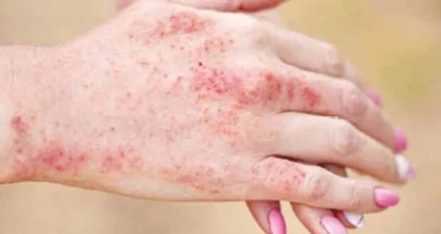 اكتشاف جيني صيني يفتح آفاقاً جديدة لعلاج مرض الذئبة