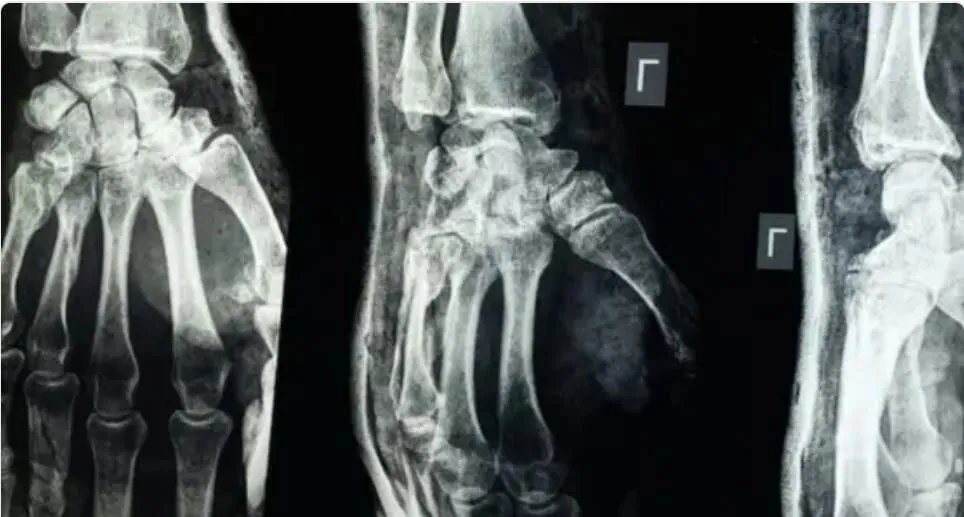 ابتكار صيني واعد: "غراء عظمي" يعالج الكسور في ثلاث دقائق ويحدث ثورة في جراحة العظام