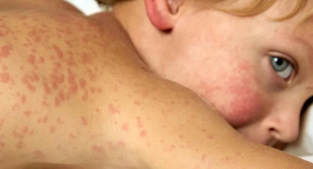 انتشار مقلق لجدري الماء بين طلاب هامبورغ: تفاصيل وتداعيات