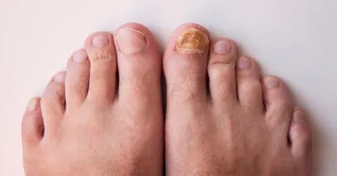 اكتشاف مذهل: أظافر القدم تكشف التعرض لغاز الرادون وخطر الإصابة بسرطان الرئة