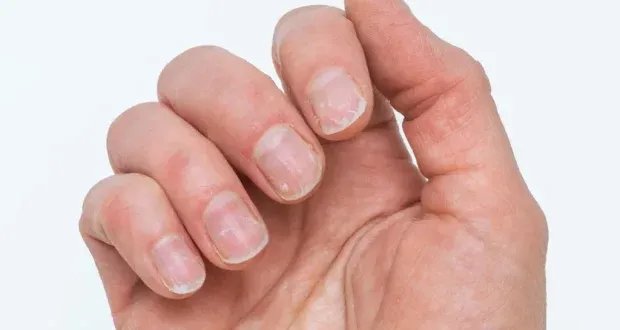 إشارات تحذيرية على الأظافر واللسان: علامات تنبئ بمشكلات صحية تستدعي الانتباه