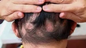 وداعاً للثعلبة والصلع الأمامي: حلول طبيعية لتحفيز نمو الشعر