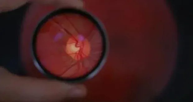 شريحة إلكترونية تعيد الأمل لفاقدي البصر: تقنية PRIMA تحدث ثورة في علاج الضمور البقعي