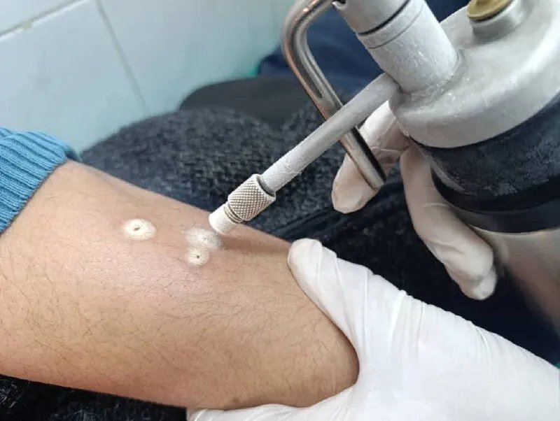 انخفاض ملحوظ في إصابات الليشمانيا بحماة بنسبة 40%.. ما الأسباب؟