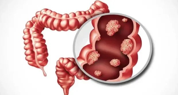دراسة تكشف: بكتيريا الأمعاء في الطفولة قد تزيد خطر الإصابة المبكرة بسرطان القولون